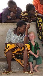 Niño albino tanzano sentado con su familia.